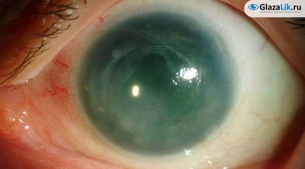 Аниридия глаз: симптомы и лечение болезни